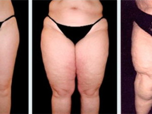 Terapija lipedema