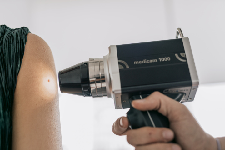uklanjanje-madeza uklanjanje madeža i ostalih kožnih promjena-sinteza skin clinic