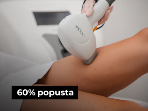 laserska epilacija dlačica